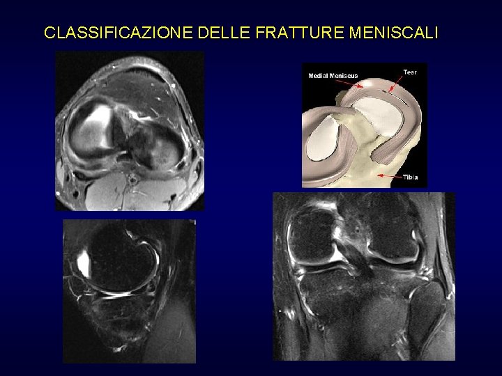 CLASSIFICAZIONE DELLE FRATTURE MENISCALI Lesione trasversale CLASSIFICAZIONE DELLE FRATTURE MENISCALI Lesione trasversale