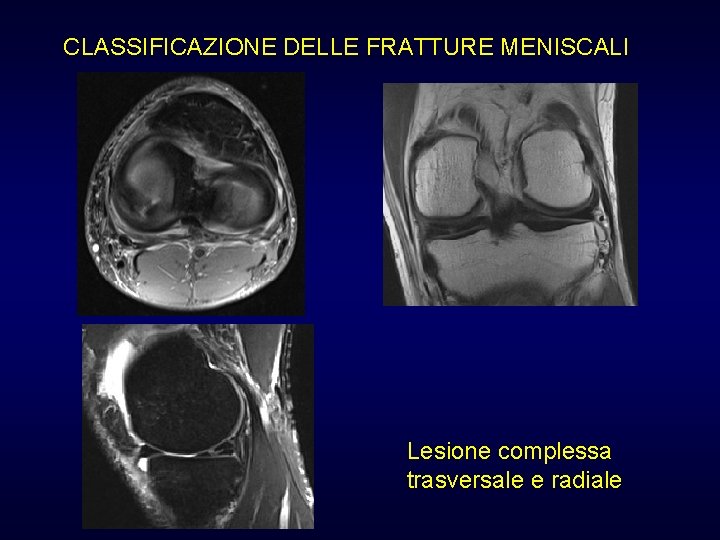 CLASSIFICAZIONE DELLE FRATTURE MENISCALI Lesione complessa trasversale e radiale CLASSIFICAZIONE DELLE FRATTURE MENISCALI Lesione complessa trasversale e radiale