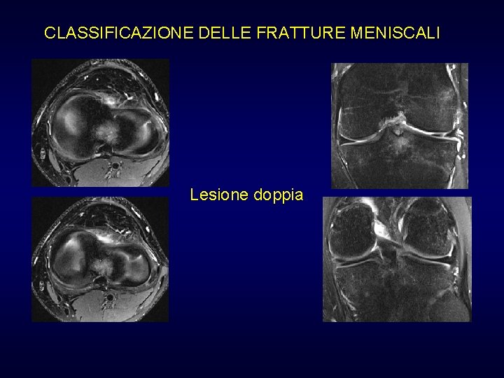 CLASSIFICAZIONE DELLE FRATTURE MENISCALI Lesione doppia CLASSIFICAZIONE DELLE FRATTURE MENISCALI Lesione doppia