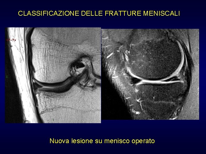 CLASSIFICAZIONE DELLE FRATTURE MENISCALI Nuova lesione su menisco operato CLASSIFICAZIONE DELLE FRATTURE MENISCALI Nuova lesione su menisco operato