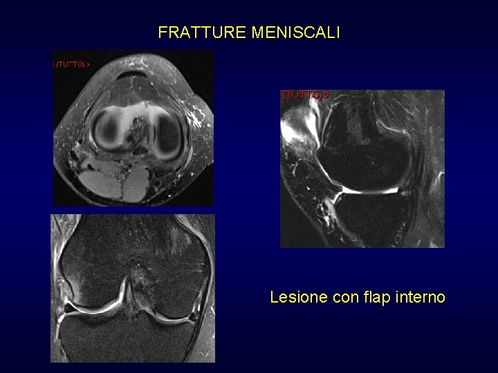 FRATTURE MENISCALI Lesione con flap interno FRATTURE MENISCALI Lesione con flap interno