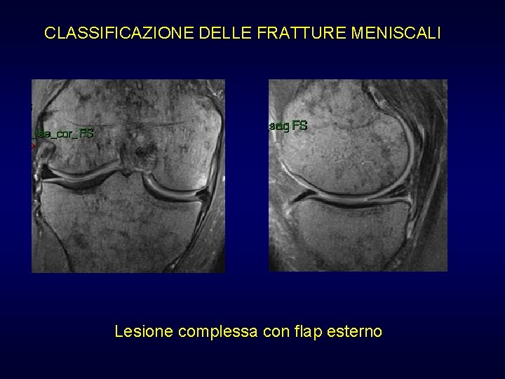 CLASSIFICAZIONE DELLE FRATTURE MENISCALI Lesione complessa con flap esterno CLASSIFICAZIONE DELLE FRATTURE MENISCALI Lesione complessa con flap esterno