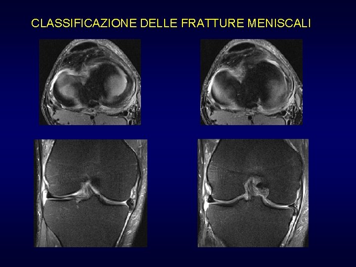 CLASSIFICAZIONE DELLE FRATTURE MENISCALI CLASSIFICAZIONE DELLE FRATTURE MENISCALI
