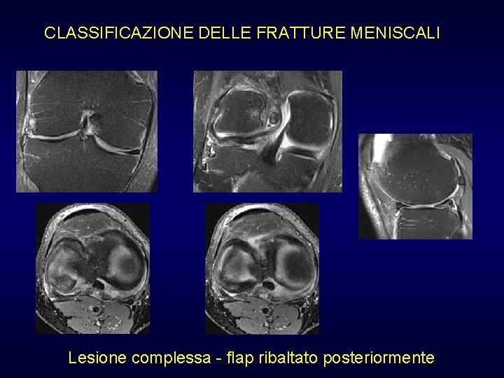 CLASSIFICAZIONE DELLE FRATTURE MENISCALI Lesione complessa - flap ribaltato posteriormente CLASSIFICAZIONE DELLE FRATTURE MENISCALI Lesione complessa - flap ribaltato posteriormente