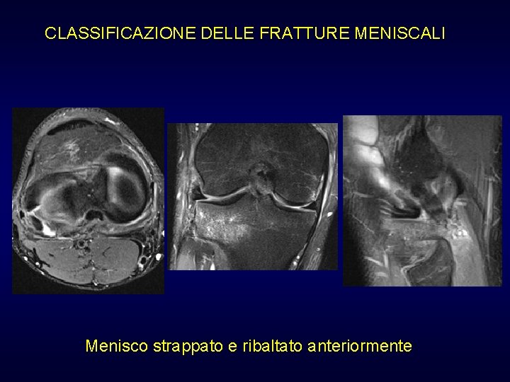 CLASSIFICAZIONE DELLE FRATTURE MENISCALI Menisco strappato e ribaltato anteriormente CLASSIFICAZIONE DELLE FRATTURE MENISCALI Menisco strappato e ribaltato anteriormente