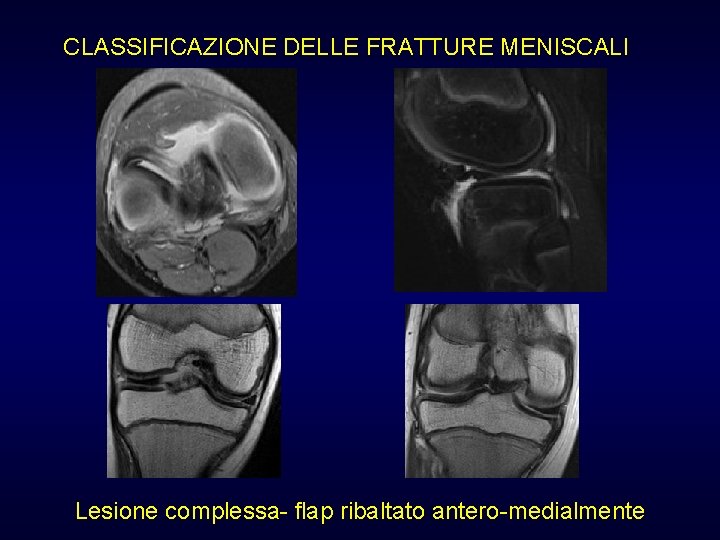 CLASSIFICAZIONE DELLE FRATTURE MENISCALI Lesione complessa- flap ribaltato antero-medialmente CLASSIFICAZIONE DELLE FRATTURE MENISCALI Lesione complessa- flap ribaltato antero-medialmente
