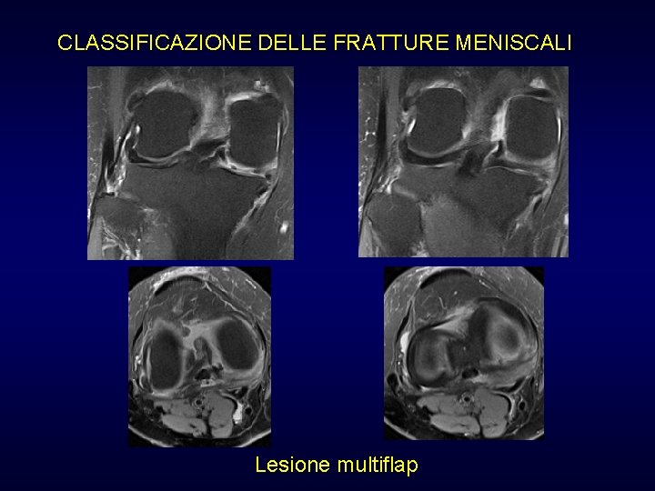 CLASSIFICAZIONE DELLE FRATTURE MENISCALI Lesione multiflap CLASSIFICAZIONE DELLE FRATTURE MENISCALI Lesione multiflap