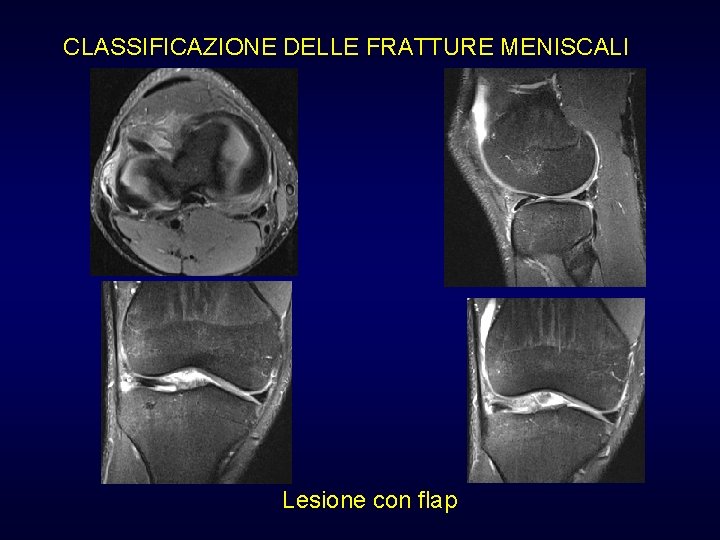 CLASSIFICAZIONE DELLE FRATTURE MENISCALI Lesione con flap CLASSIFICAZIONE DELLE FRATTURE MENISCALI Lesione con flap