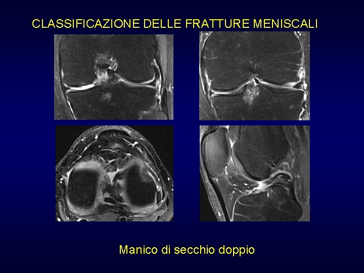 CLASSIFICAZIONE DELLE FRATTURE MENISCALI Manico di secchio doppio CLASSIFICAZIONE DELLE FRATTURE MENISCALI Manico di secchio doppio