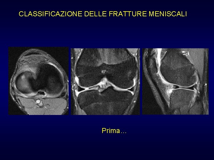 CLASSIFICAZIONE DELLE FRATTURE MENISCALI Prima… CLASSIFICAZIONE DELLE FRATTURE MENISCALI Prima…