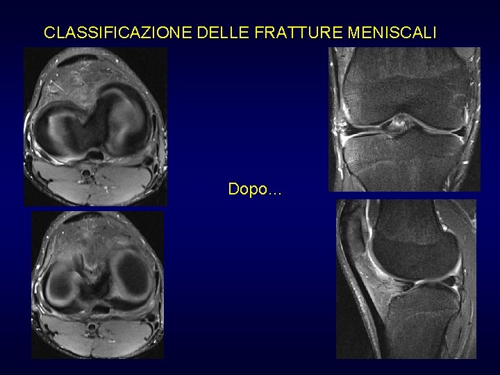 CLASSIFICAZIONE DELLE FRATTURE MENISCALI Dopo… CLASSIFICAZIONE DELLE FRATTURE MENISCALI Dopo…