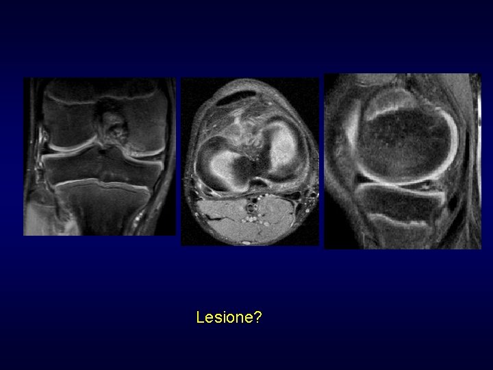 Lesione? Lesione?