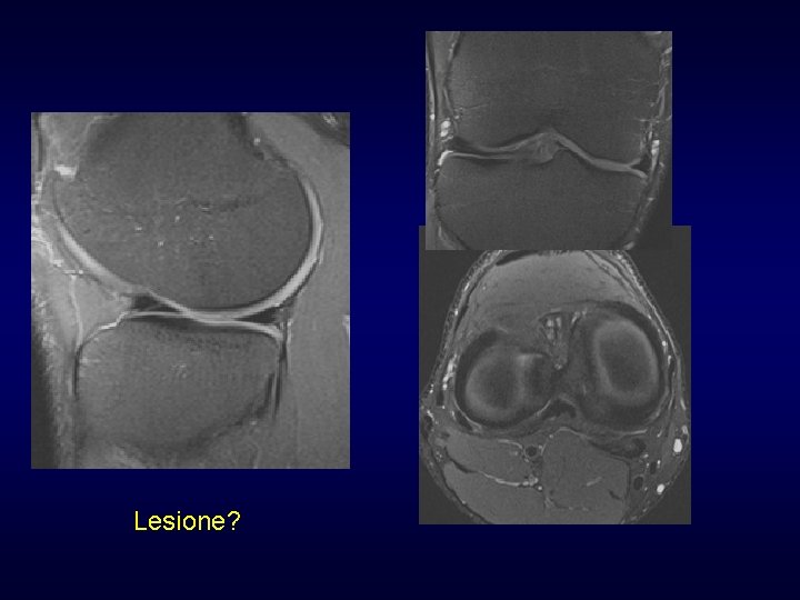 Lesione? Lesione?