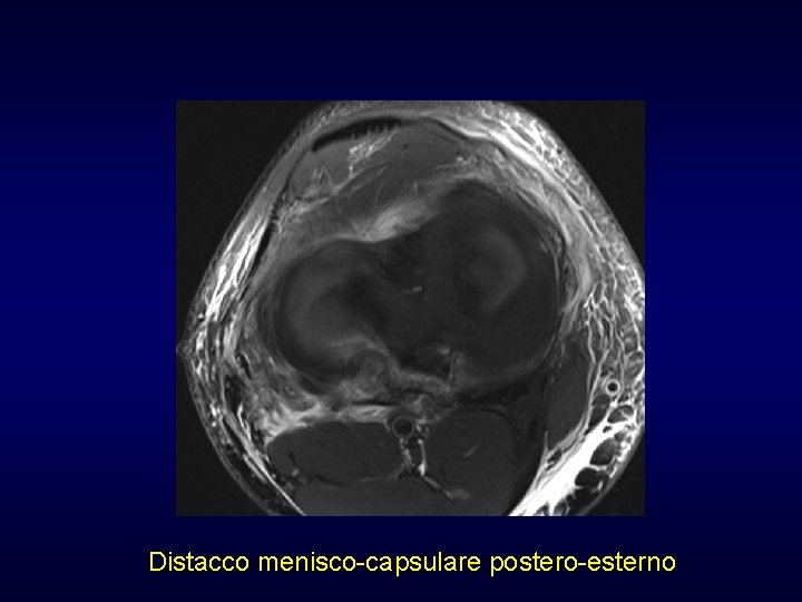 Distacco menisco-capsulare postero-esterno Distacco menisco-capsulare postero-esterno