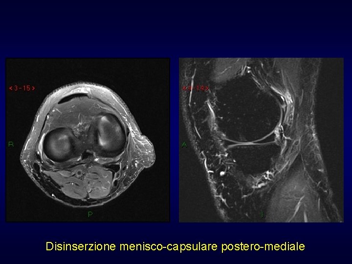 Disinserzione menisco-capsulare postero-mediale Disinserzione menisco-capsulare postero-mediale