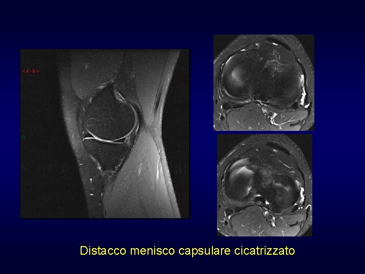 Distacco menisco capsulare cicatrizzato Distacco menisco capsulare cicatrizzato