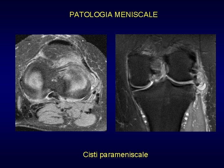 PATOLOGIA MENISCALE Cisti parameniscale PATOLOGIA MENISCALE Cisti parameniscale