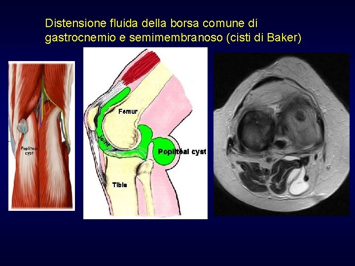 Distensione fluida della borsa comune di gastrocnemio e semimembranoso (cisti di Baker) Distensione fluida della borsa comune di gastrocnemio e semimembranoso (cisti di Baker)