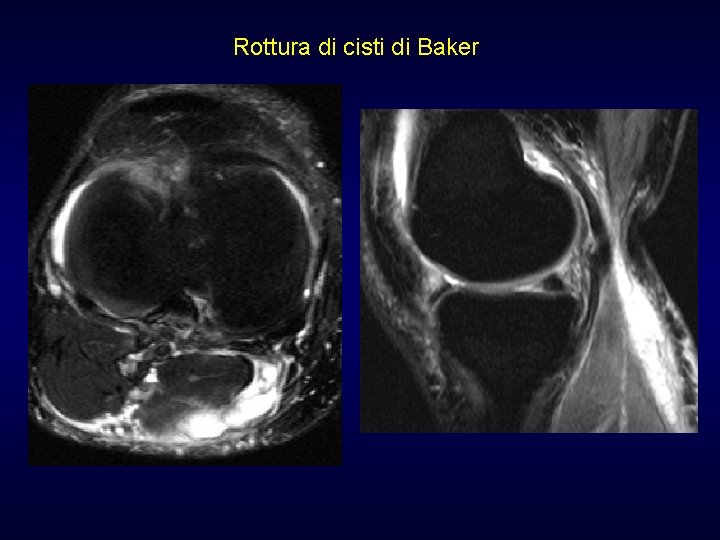 Rottura di cisti di Baker Rottura di cisti di Baker