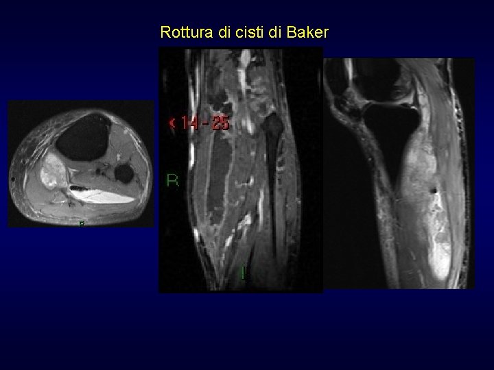 Rottura di cisti di Baker Rottura di cisti di Baker