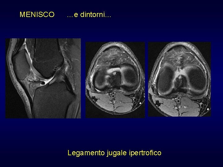 MENISCO …e dintorni… Legamento jugale ipertrofico MENISCO …e dintorni… Legamento jugale ipertrofico