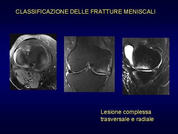 CLASSIFICAZIONE DELLE FRATTURE MENISCALI Lesione complessa trasversale e radiale CLASSIFICAZIONE DELLE FRATTURE MENISCALI Lesione complessa trasversale e radiale