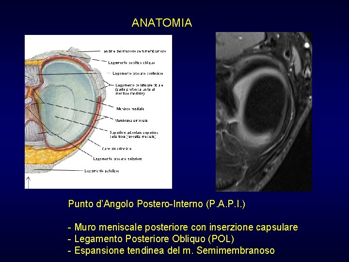 ANATOMIA Punto d’Angolo Postero-Interno (P. A. P. I. ) - Muro meniscale posteriore con ANATOMIA Punto d’Angolo Postero-Interno (P. A. P. I. ) - Muro meniscale posteriore con