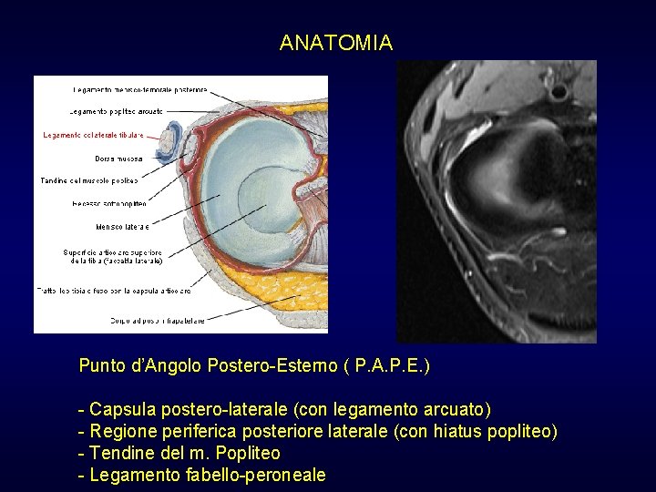 ANATOMIA Punto d’Angolo Postero-Esterno ( P. A. P. E. ) - Capsula postero-laterale (con ANATOMIA Punto d’Angolo Postero-Esterno ( P. A. P. E. ) - Capsula postero-laterale (con