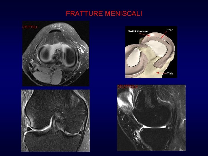 FRATTURE MENISCALI FRATTURE MENISCALI