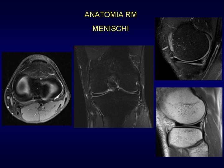 ANATOMIA RM MENISCHI ANATOMIA RM MENISCHI