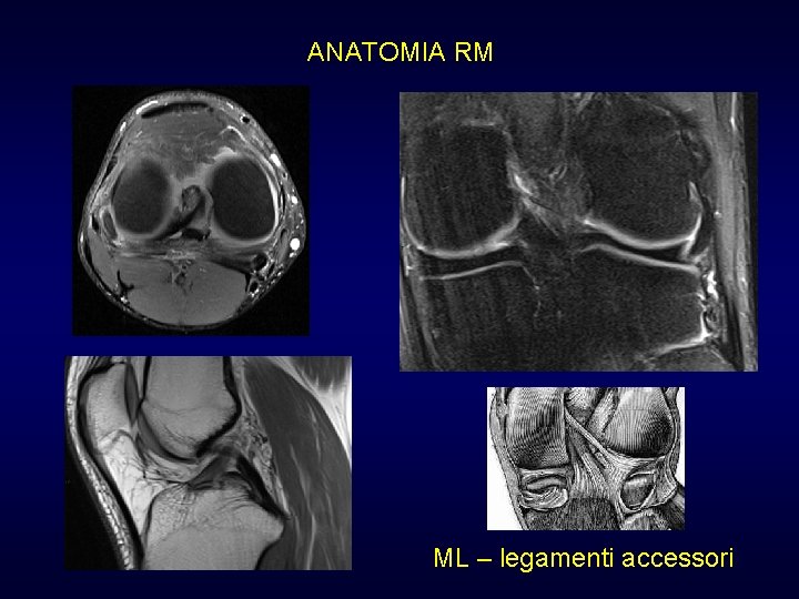 ANATOMIA RM ML – legamenti accessori ANATOMIA RM ML – legamenti accessori