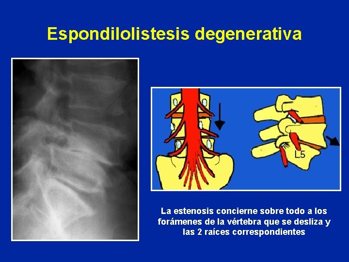 Espondilolistesis degenerativa La estenosis concierne sobre todo a los forámenes de la vértebra que
