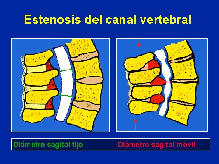 Estenosis del canal vertebral Diámetro sagital fijo Diámetro sagital móvil 