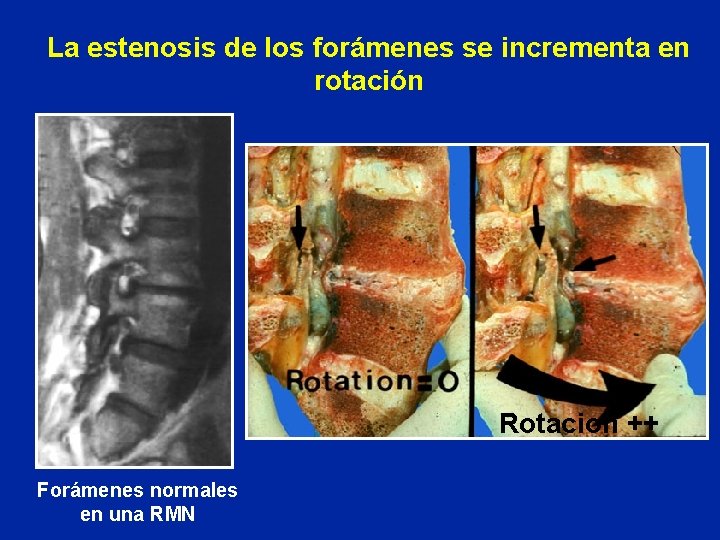 La estenosis de los forámenes se incrementa en rotación Rotacion ++ Forámenes normales en