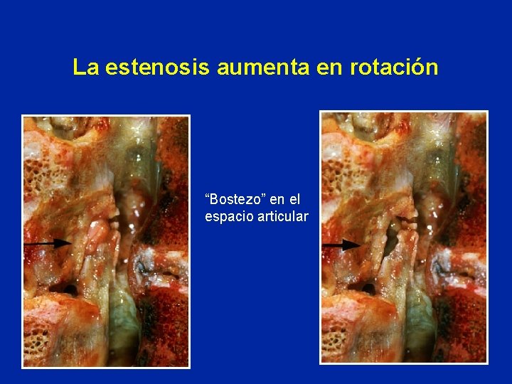 La estenosis aumenta en rotación “Bostezo” en el espacio articular 