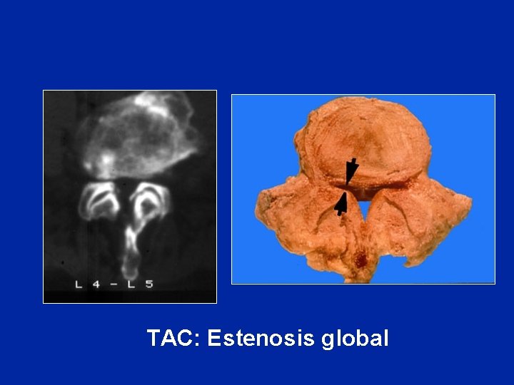 TAC: Estenosis global 