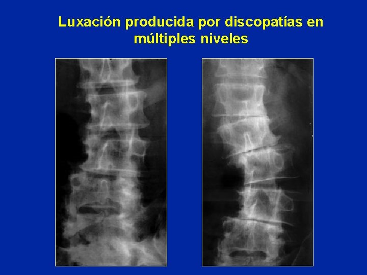 Luxación producida por discopatías en múltiples niveles 
