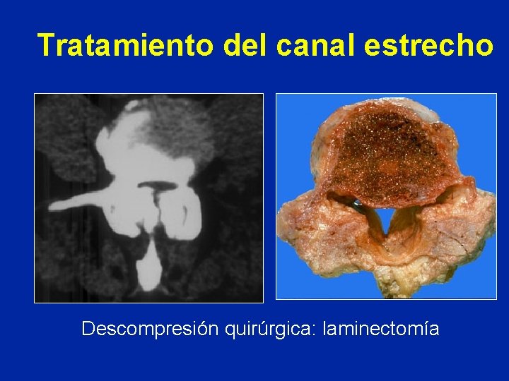 Tratamiento del canal estrecho Descompresión quirúrgica: laminectomía 
