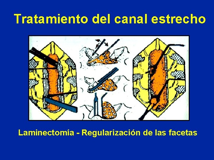 Tratamiento del canal estrecho Laminectomía - Regularización de las facetas 