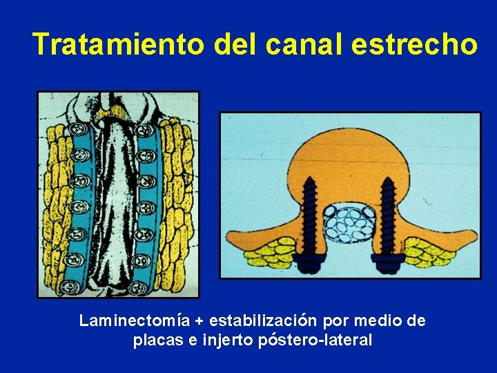 Tratamiento del canal estrecho Laminectomía + estabilización por medio de placas e injerto póstero-lateral