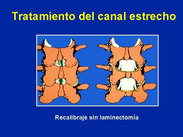 Tratamiento del canal estrecho Recalibraje sin laminectomía 