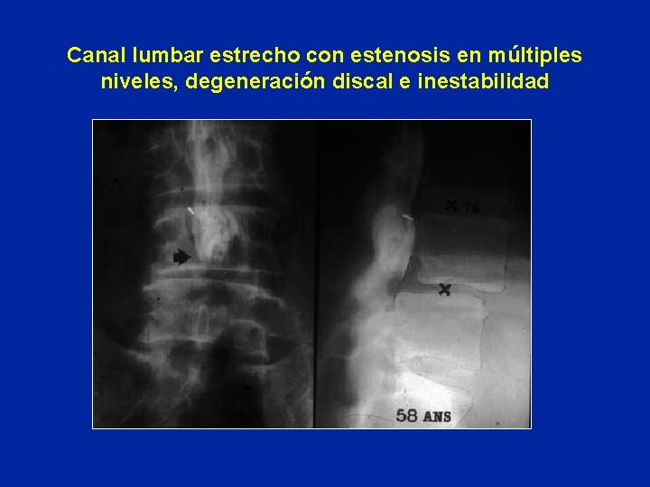 Canal lumbar estrecho con estenosis en múltiples niveles, degeneración discal e inestabilidad 