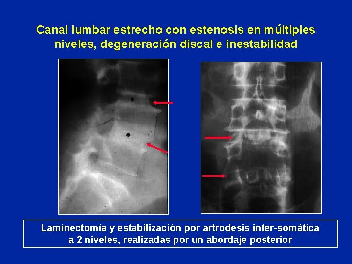 Canal lumbar estrecho con estenosis en múltiples niveles, degeneración discal e inestabilidad Laminectomía y