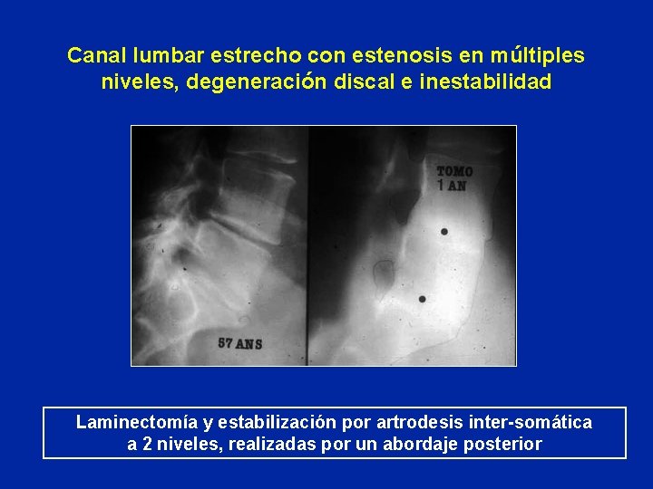 Canal lumbar estrecho con estenosis en múltiples niveles, degeneración discal e inestabilidad Laminectomía y