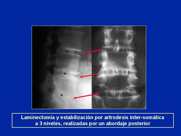 Laminectomía y estabilización por artrodesis inter-somática a 3 niveles, realizadas por un abordaje posterior