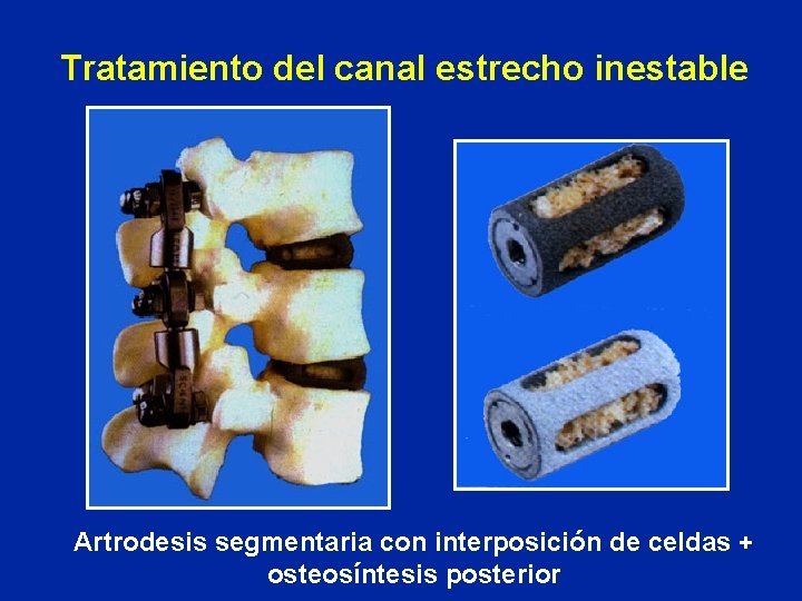 Tratamiento del canal estrecho inestable Artrodesis segmentaria con interposición de celdas + osteosíntesis posterior