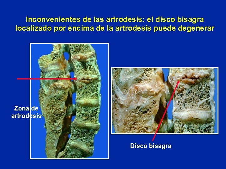 Inconvenientes de las artrodesis: el disco bisagra localizado por encima de la artrodesis puede