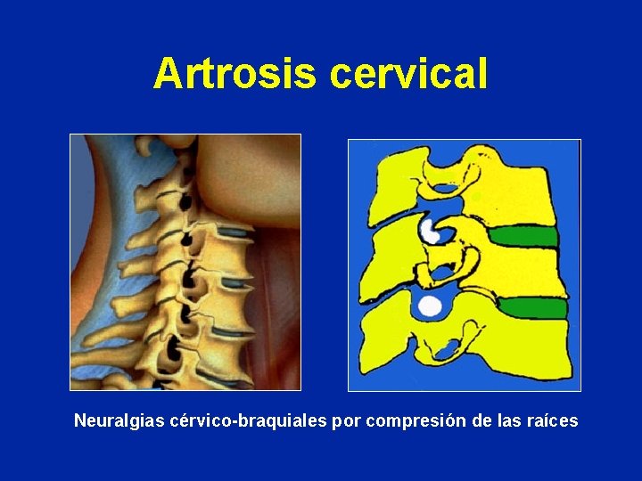 Artrosis cervical Neuralgias cérvico-braquiales por compresión de las raíces 