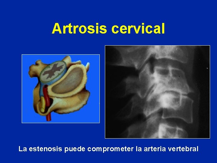 Artrosis cervical La estenosis puede comprometer la arteria vertebral 