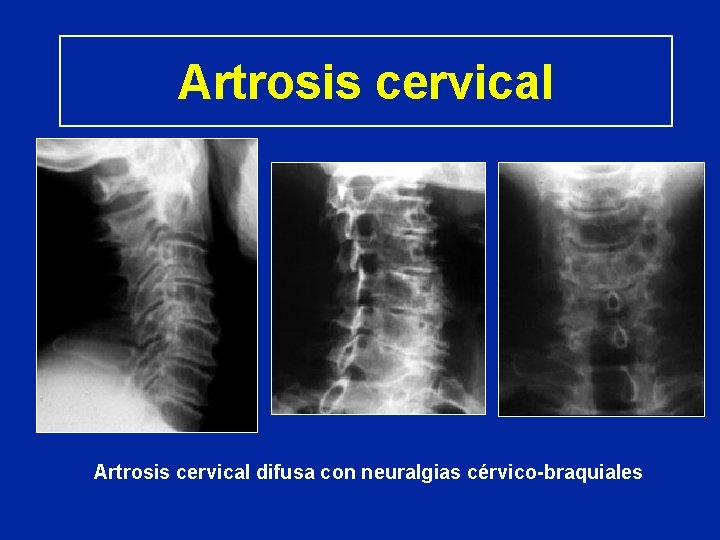 Artrosis cervical difusa con neuralgias cérvico-braquiales 